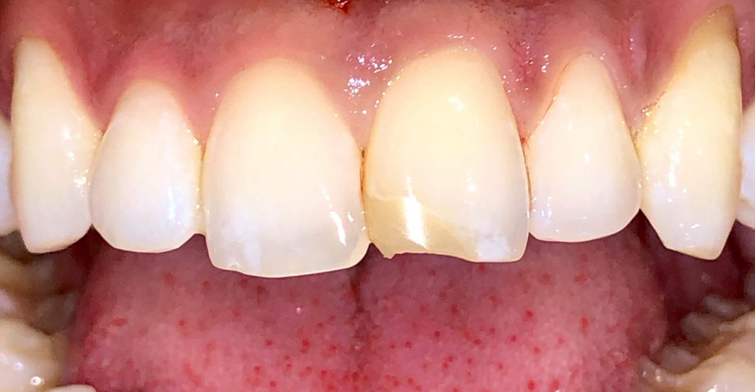 Porcelain Veneers Miami FL